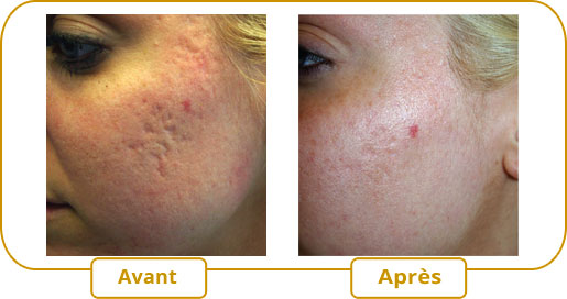 Traitement des cicatrices d’acné avec eMatrix