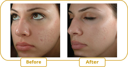 Treatment of acne scars with eMatrix