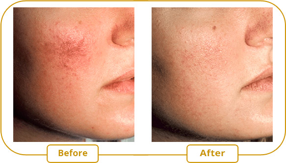 Rosacea Laser treatment with VBeam Perfecta