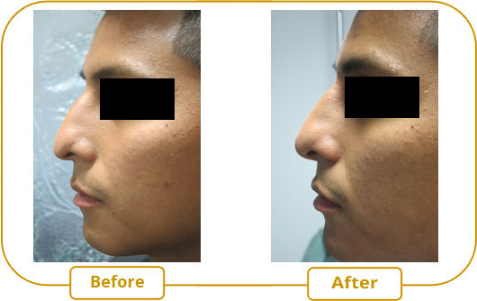 Non-surgical rhinoplasty before after left side