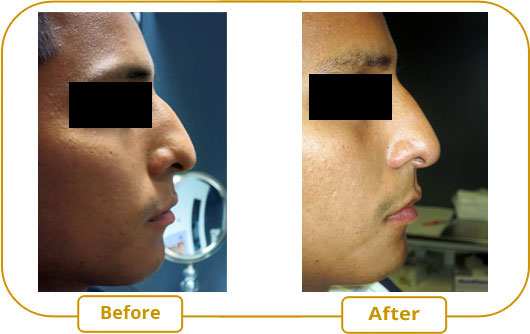 Non-surgical rhinoplasty before after right side