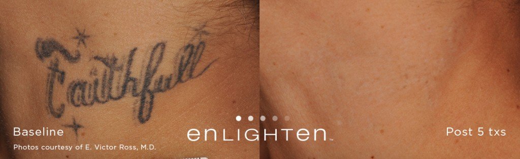 Enlighten ™ pour effacer les tatouages et détatouage technologie