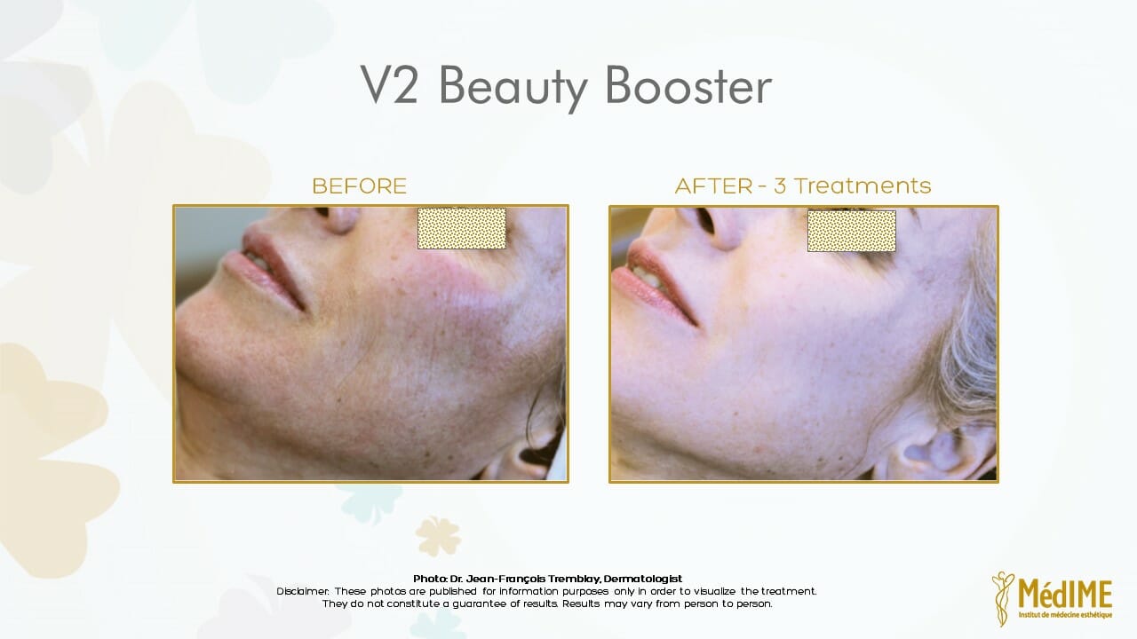 v2-beauty-booster-before-after